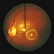 Cysticerosis